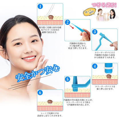 Inzyla Skin Tag Removal Tool Kit with 4 Sizes for Easy Use