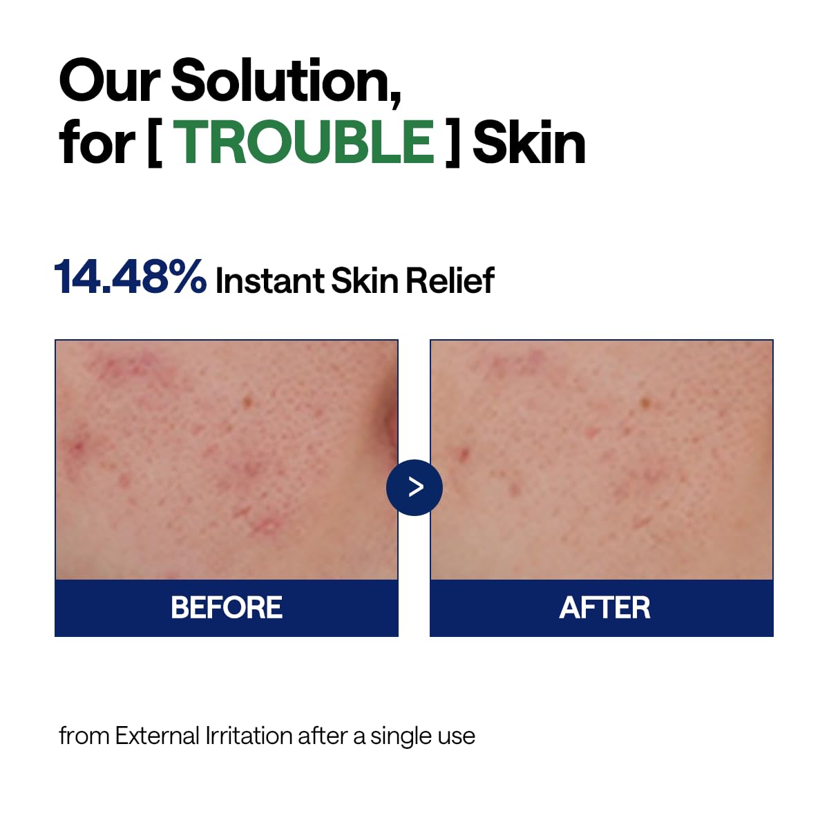 MEDIHEAL Tea Tree Calming Serum 40ml for Moisture Support